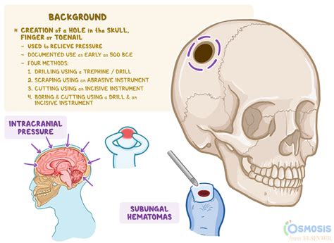 what is trepanation used for.